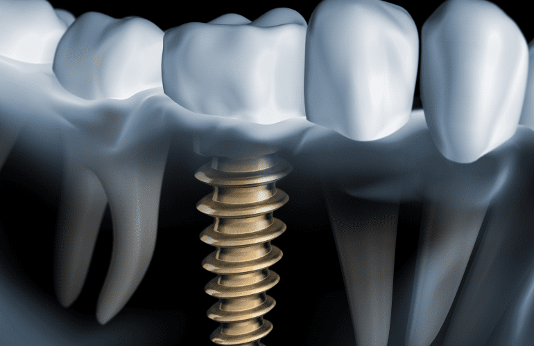 Pierderea unui dinte sau mai multor dinți afectează funcționalitatea aparatului dento-maxilar. Alegerea informată a unui tratament de reconstrucție dentară cu ajutorul implanturilor vă oferă o soluție modernă de refacere a integrității arcadelor dentare.