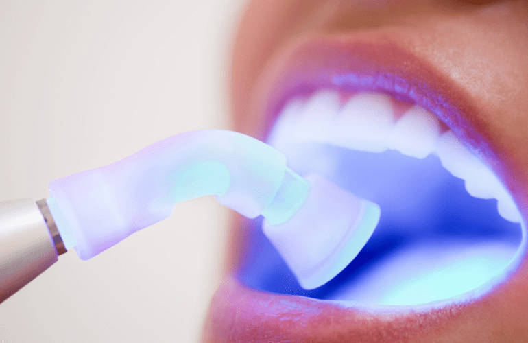 igienizare laser dental