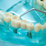 Implant dentar Cluj