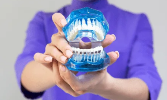 Implant dentar Cluj – Restaurarea completa a zambetului tau 3 Screenshot 263