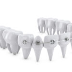 dental brackets