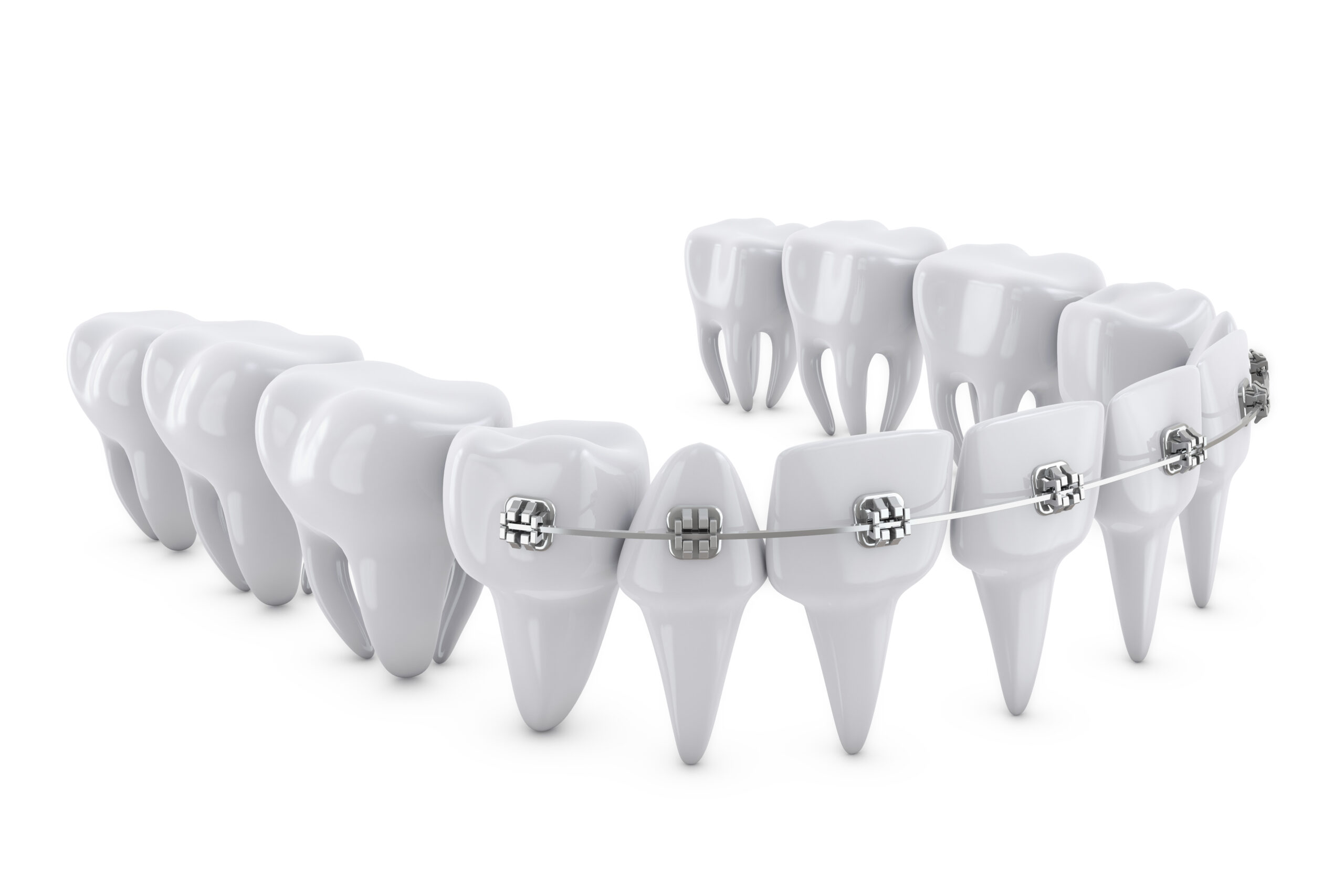 dental brackets scaled